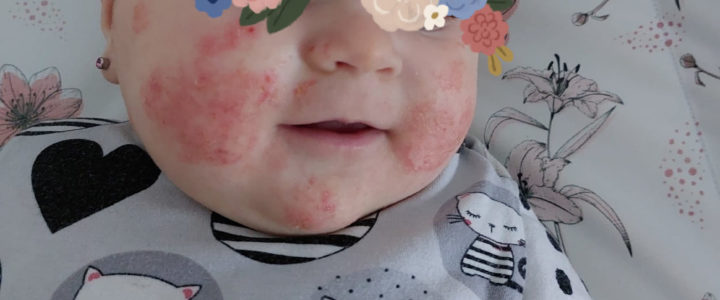 ABKM – Projevy a možnosti řešení při zachování kojení ABKM – Projevy a možnosti řešení při zachování kojení